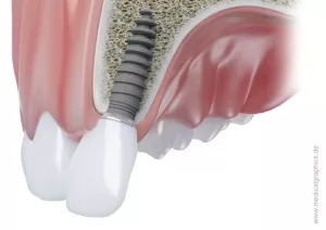 Bild: Implantat eines Schneidezahns im Oberkiefer
