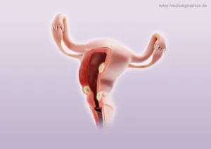 Bild: Myome Uterus (unten)