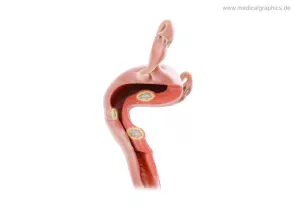 Bild: Myome Uterus (recht)