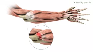 Bild: Tennisarm