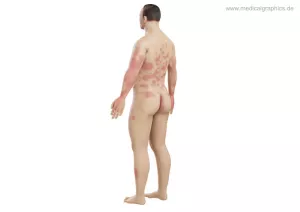 Bild: Mensch Psoriasis (seitlich-hinten)