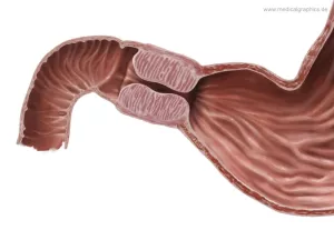 Bild: Pylorusstenose