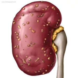Bild: Pyelonephritis