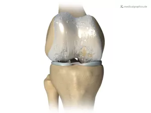 Bild: Knie mit Arthrose (behandelt)