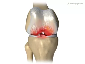 Bild: Knie mit Arthrose
