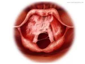 Bild: Krupp (akute obstruktive Laryngitis)