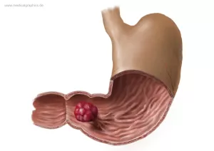 Bild: Magenpolyp