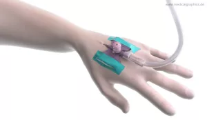 Bild: Intravenöser Zugang am Handrücken
