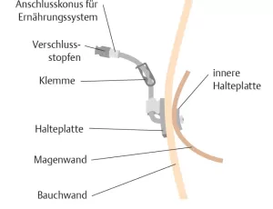 Bild: I care Pflege | Pflegetechniken | Liegende PEG (Grafik)