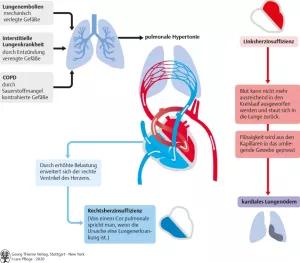 Bild: I care Pflege | Pflege bei speziellen Erkrankungen | Pulmonale Hypertonie (Grafik)