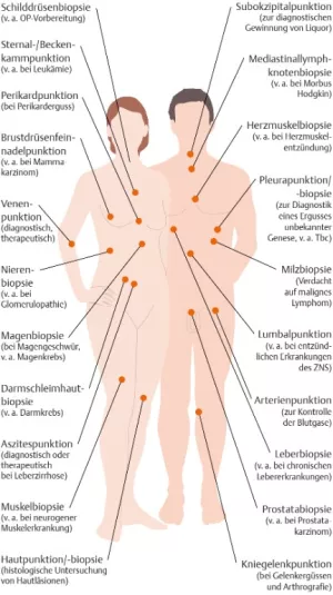 Bild: I care Pflege | Pflegetechniken | Häufige Stellen für Punktionen und Biopsien (Grafik)