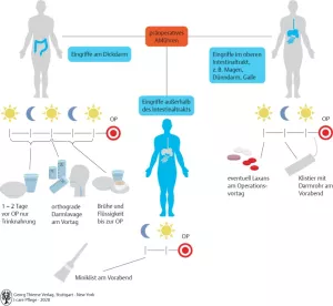 Bild: I care Pflege | Unterschiedliche Pflegesettings | Präoperatives Abführen (Grafik)