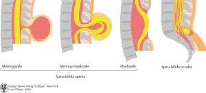 Bild: I care Pflege | Pflege bei speziellen Erkrankungen | Neuralrohrdefekt (Grafik)