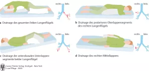 Bild: I care Pflege | Pflege bei speziellen Erkrankungen | Drainagelagerung (Grafik)
