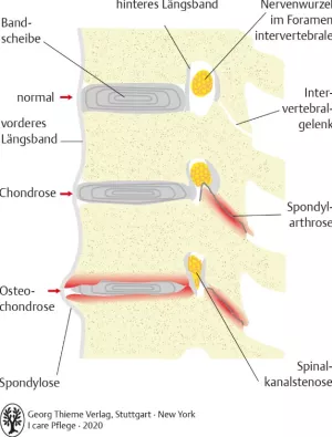 Bild: I care Pflege | Pflege bei speziellen Erkrankungen | Degenerative Wirbelsäulenerkrankungen (Grafik)