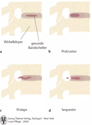 Bild: I care Pflege | Pflege bei speziellen Erkrankungen | Bandscheibenvorfälle (Grafik)