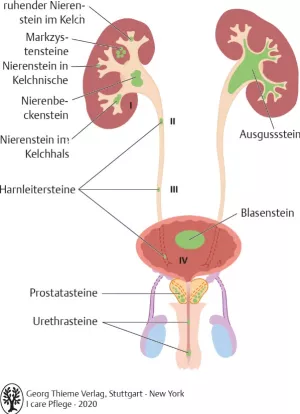 Bild: I care Krankheitslehre | Spezielle Krankheitslehre | Lokalisation von Harnsteinen (Grafik)