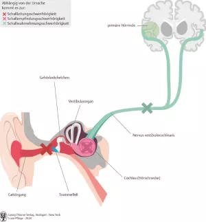 Bild: I care Krankheitslehre | Spezielle Krankheitslehre | Formen der Schwerhörigkeit (Grafik)