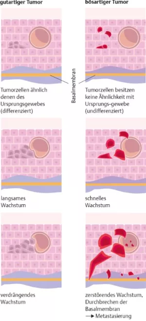 Bild: I care Krankheitslehre | Grundlagen | Gutartiger und bösartiger Tumor (Grafik)