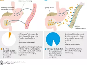 Bild: I care Krankheitslehre | Spezielle Krankheitslehre | Entstehung des Diabetes mellitus Typ 1 und Typ 2 (Grafik)