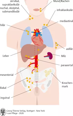 Bild: I care Krankheitslehre | Spezielle Krankheitslehre | Lokalisation der Lymphknotenschwellungen bei malignen Lymphomen (Grafik)