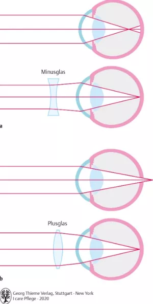Bild: I care Krankheitslehre | Spezielle Krankheitslehre | Fehlsichtigkeit (Grafik)