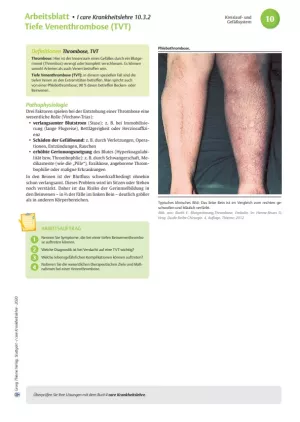 Arbeitsblatt: I care Krankheitslehre | Spezielle Krankheitslehre | Tiefe Venenthrombose (Arbeitsblatt)