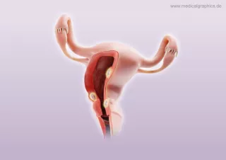 Bild: Myome Uterus (unten)