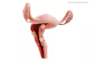 Bild: Myome Uterus (seitlich)