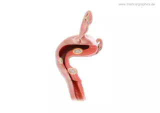 Bild: Myome Uterus (recht)
