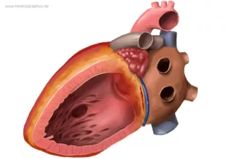 Bild: Ventrikelseptumdefekt