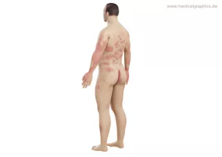 Bild: Mensch Psoriasis (seitlich-hinten)