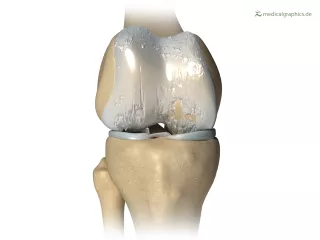 Bild: Knie mit Arthrose (behandelt)