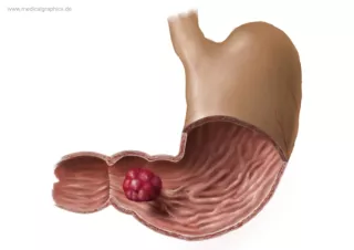 Bild: Magenpolyp