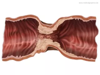 Bild: Einschnürendes Adenokarzinom Colon Transversum