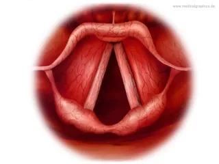 Bild: Akute Laryngitis