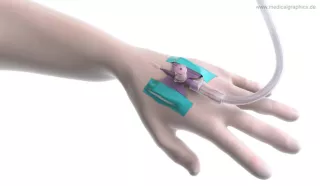 Bild: Intravenöser Zugang am Handrücken