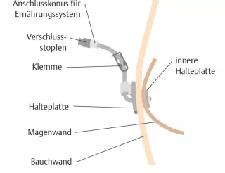 Bild: I care Pflege | Pflegetechniken | Liegende PEG (Grafik)