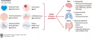 Bild: I care Pflege | Pflege bei speziellen Erkrankungen | Akuter Arterienverschluss (Grafik)