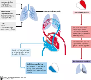 Bild: I care Pflege | Pflege bei speziellen Erkrankungen | Pulmonale Hypertonie (Grafik)