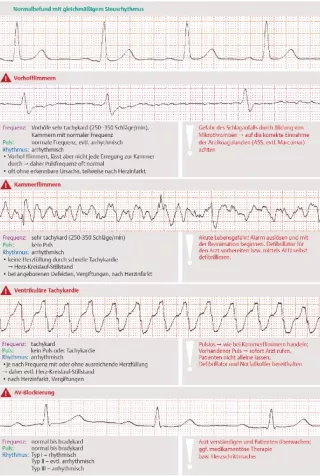Bild: I care Pflege | Pflege bei speziellen Erkrankungen | Herzrhythmusstörungen (Grafik)
