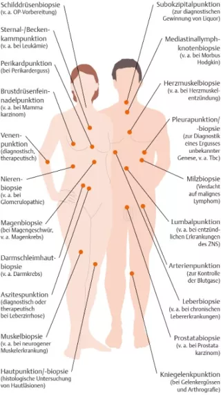 Bild: I care Pflege | Pflegetechniken | Häufige Stellen für Punktionen und Biopsien (Grafik)