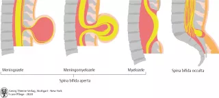 Bild: I care Pflege | Pflege bei speziellen Erkrankungen | Neuralrohrdefekt (Grafik)