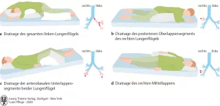 Bild: I care Pflege | Pflege bei speziellen Erkrankungen | Drainagelagerung (Grafik)