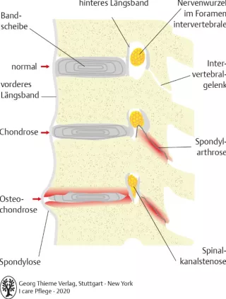 Bild: I care Pflege | Pflege bei speziellen Erkrankungen | Degenerative Wirbelsäulenerkrankungen (Grafik)