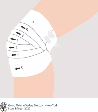 Bild: I care Pflege | Pflegetechniken | Schildkrötenverband am Knie (Grafik)