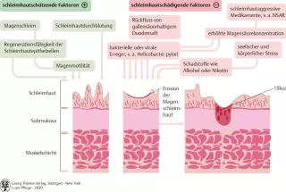 Bild: I care Pflege | Pflege bei speziellen Erkrankungen | Gastritis (Grafik)