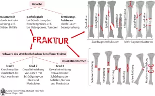 Bild: I care Pflege | Pflege bei speziellen Erkrankungen | Klassifikation von Frakturen (Grafik)