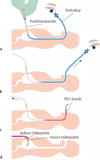 Bild: I care Pflege | Pflegetechniken | PEG-Anlage (Grafik)
