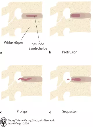 Bild: I care Pflege | Pflege bei speziellen Erkrankungen | Bandscheibenvorfälle (Grafik)